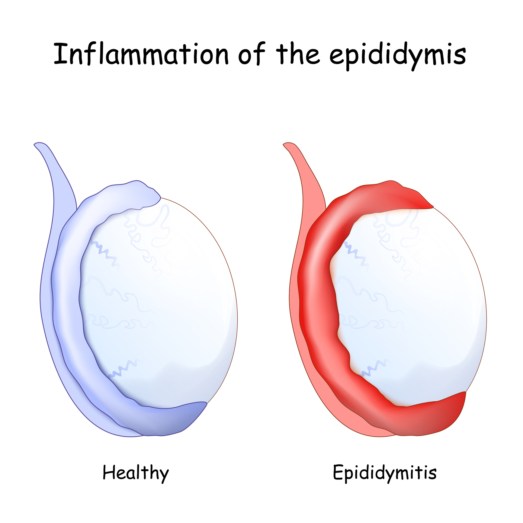 Ultrasonography Of Epididymitis And Epididymo Orchitis LXFPA